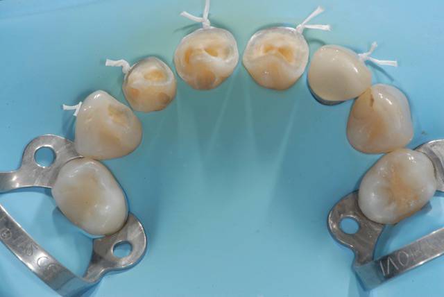 Diga di gomma, garanzia di qualità e sicurezza dal dentista